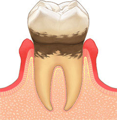 歯周炎(中度の歯周病)