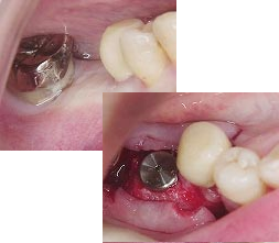 インプラント手術（二回法）1次手術