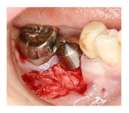 インプラント手術（二回法）2次手術