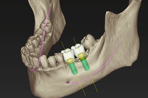インプラント治療計画ソフトウェア