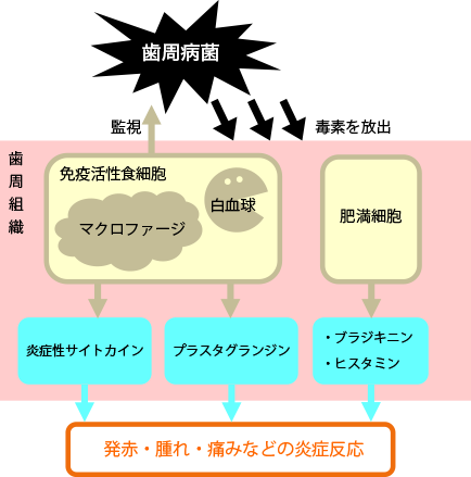 歯周病が進行するメカニズム