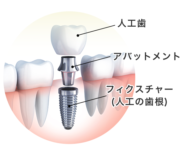 インプラントの構造