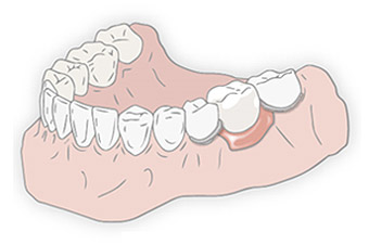 部分入れ歯