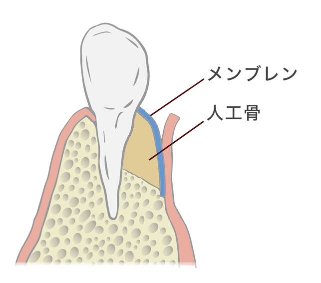 再生治療