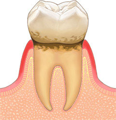 歯肉炎(軽度の歯周病)