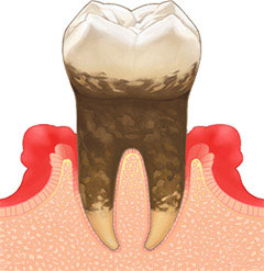 歯周炎(重度の歯周病)