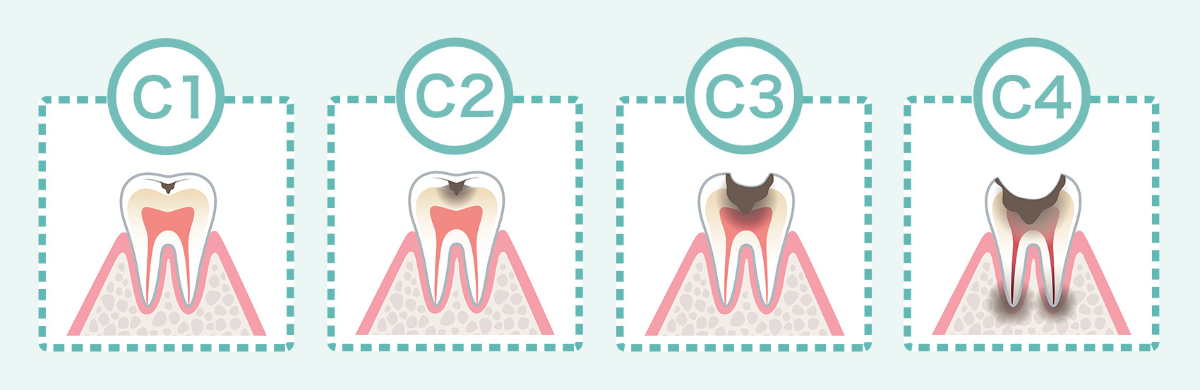 虫歯の進行