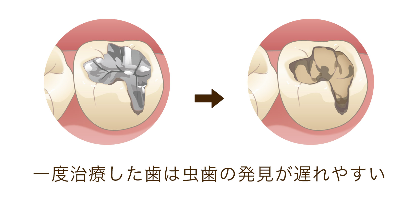 二次カリエス