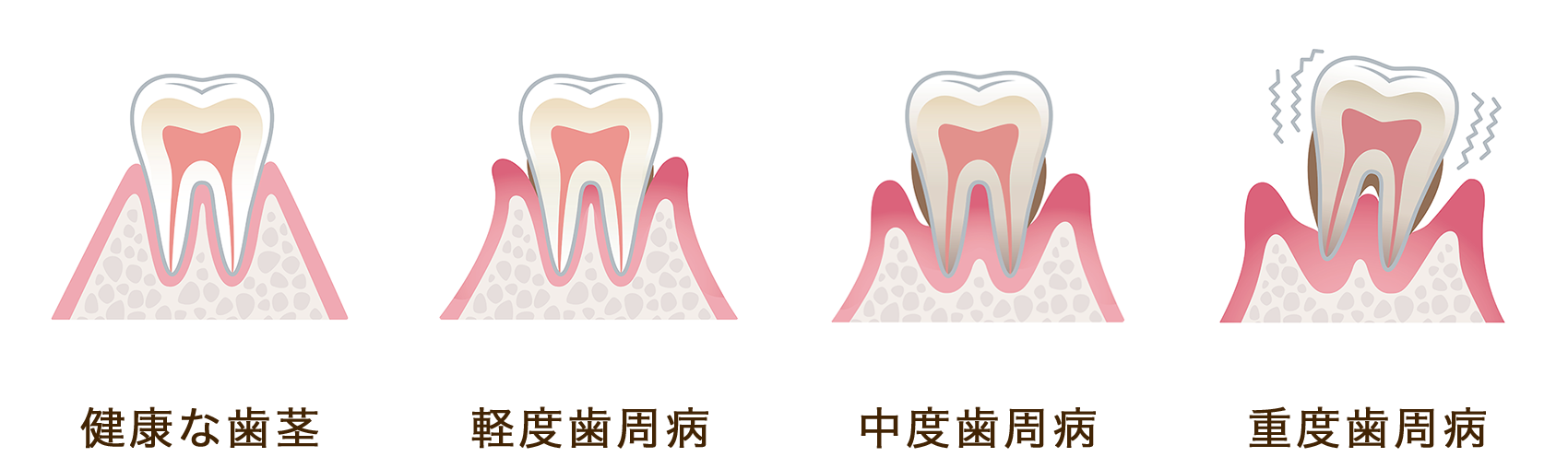 歯周病の進行