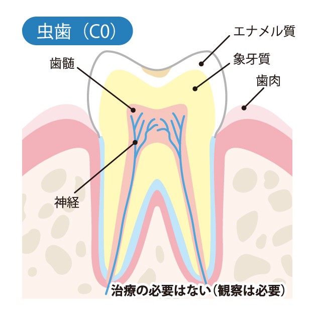 初期虫歯ってどんな状態？