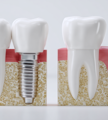 インプラントとブリッジ、それぞれの基本的な特徴を教えてください