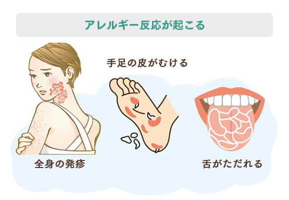金属アレルギーのメカニズム